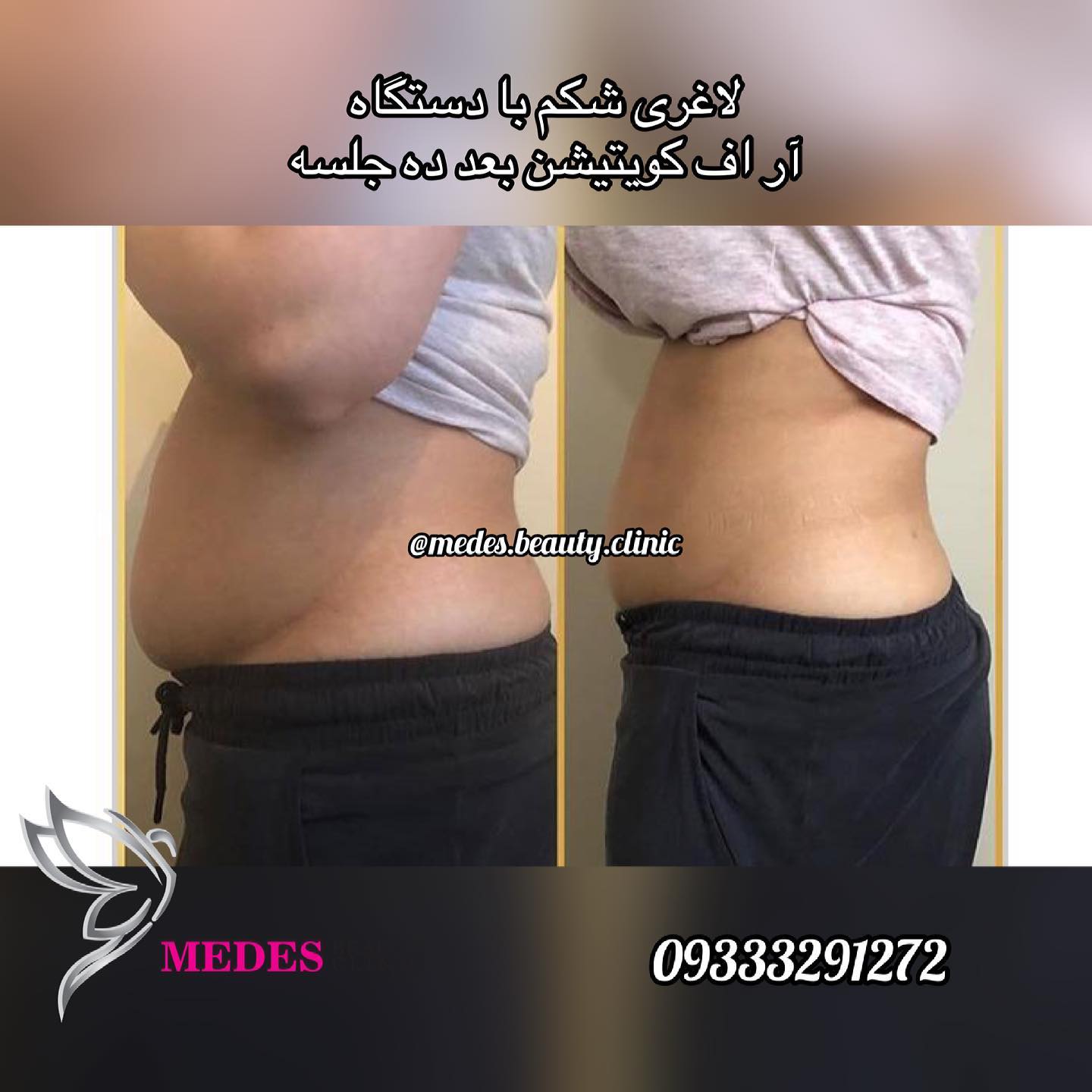 گالری لاغری با دستگاه